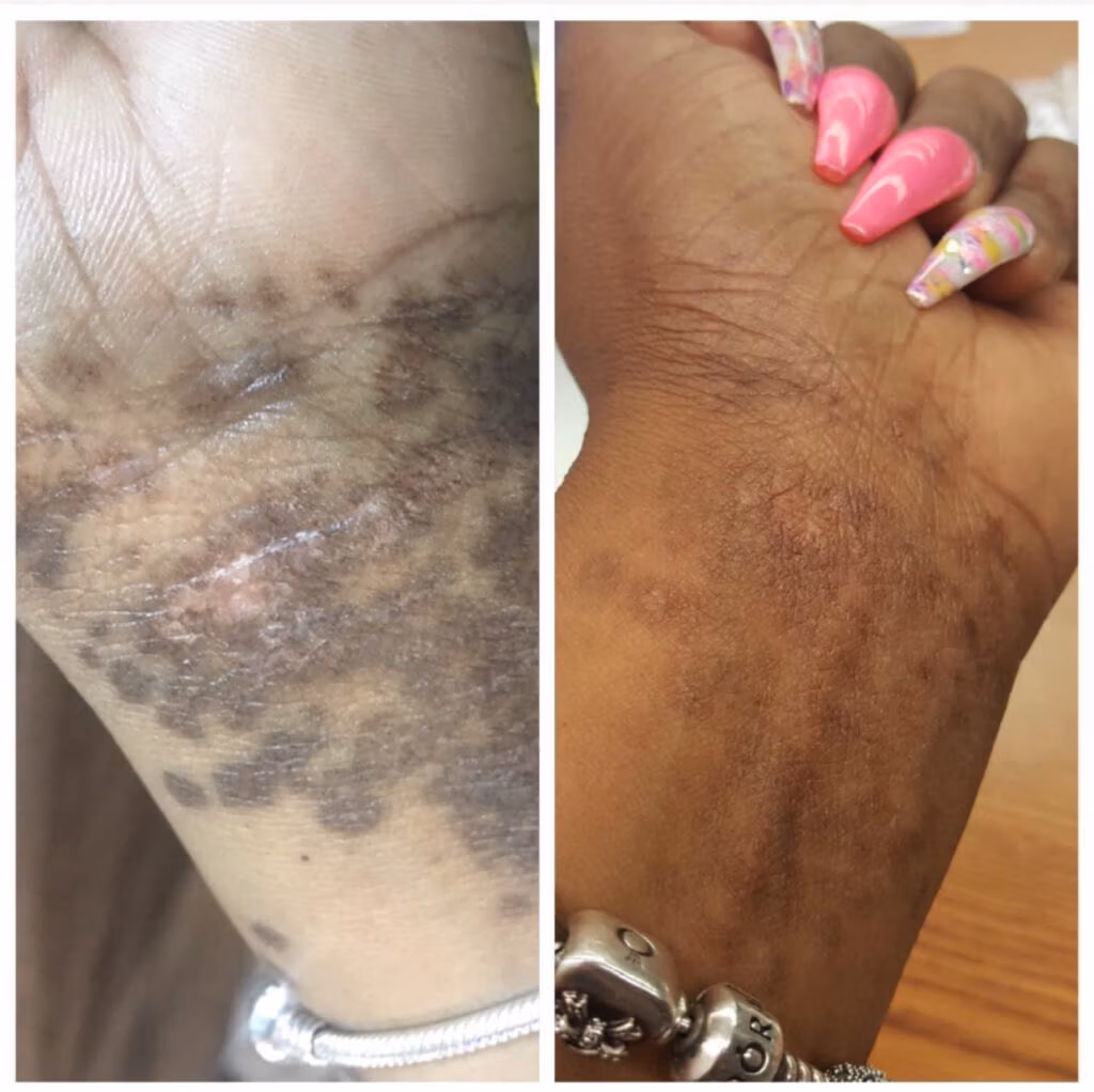 Customer with Lichen Planus - Dark Marks | Donata Skinfood