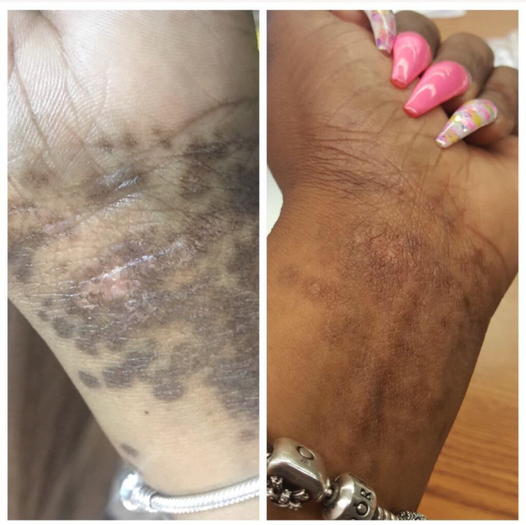 Customer with Lichen Planus - Dark Marks | Donata Skinfood