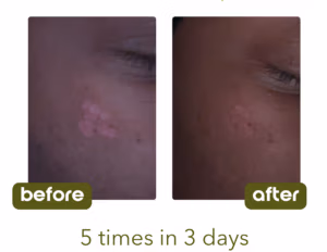 Customer used the Scar Butter 5 times in 3 days before and after picture