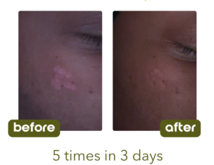 Customer used the Scar Butter 5 times in 3 days before and after picture